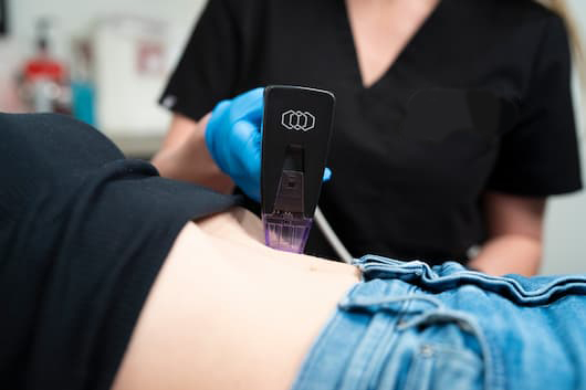 מכשיר Morpheus8 במרפאת VIV